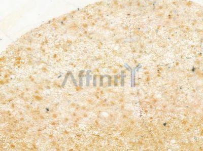 DNAL1 Antibody - DF4014 at 1/100 staining human astrocytoma by IHC-P.