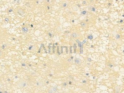 EPN2 Antibody - DF4045 at 1/100 staining human astrocytoma by IHC-P.