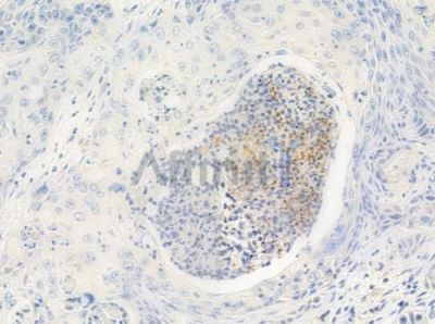 HNRCL Antibody - DF4115 at 1/100 staining human esophageal carcinoma by IHC-P.