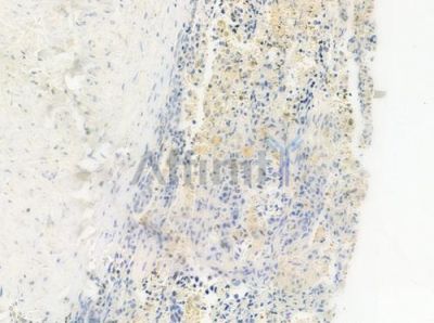 MYH15 Antibody - DF4197 at 1/100 staining human lung squamous cell carcinoma by IHC-P.
