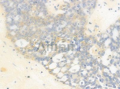 NDUFA8 Antibody - DF4205 at 1/100 staining human ovarian carcinoma by IHC-P.