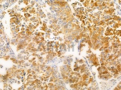NDUFB9 Antibody - DF4208 at 1/100 staining human lung squamous cell carcinoma by IHC-P.