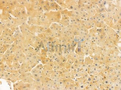 NDUFB9 Antibody - DF4208 at 1/100 staining human hepatocellular carcinoma by IHC-P.