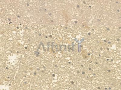NXPH3 Antibody - DF4231 at 1/100 staining human glioblastoma by IHC-P.