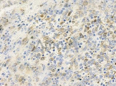 NBPF5 Antibody - DF4234 at 1/100 staining human melanoma by IHC-P.