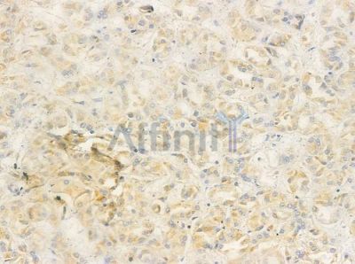PDRG1 Antibody - DF4273 at 1/100 staining human renal cell carcinoma by IHC-P.