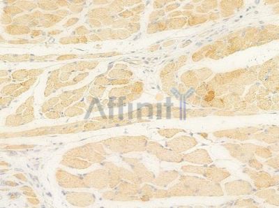 PECI Antibody - DF4279 at 1/100 staining human tongue carcinoma by IHC-P.
