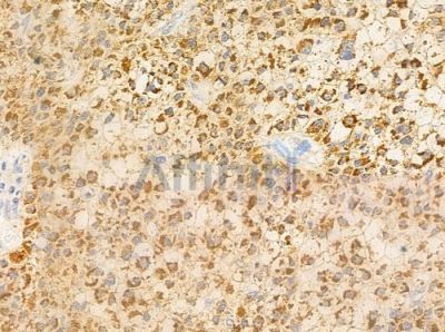 PECI Antibody - DF4279 at 1/100 staining human hepatocellular carcinoma by IHC-P.