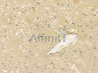 PKP4 Antibody - DF4298 at 1/100 staining human glioblastoma by IHC-P.