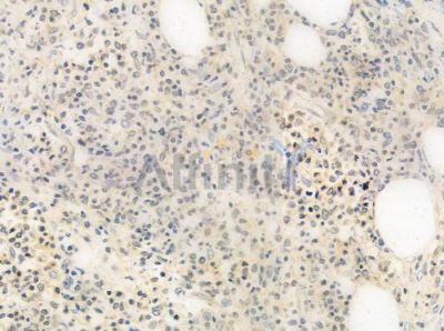 POLDIP3 Antibody - DF4304 at 1/100 staining human Hodgkin lymphoma by IHC-P.