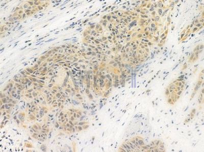 POLDIP3 Antibody - DF4304 at 1/100 staining human pancreatic carcinoma by IHC-P.