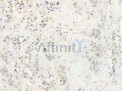 POLDIP3 Antibody - DF4304 at 1/100 staining human esophageal carcinoma by IHC-P.