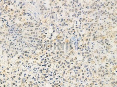 PRPF18 Antibody - DF4328 at 1/100 staining human Hodgkin lymphoma by IHC-P.