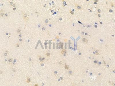 PRPF18 Antibody - DF4328 at 1/100 staining human glioblastoma by IHC-P.