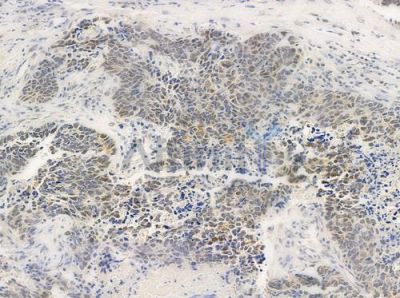 PRPF18 Antibody - DF4328 at 1/100 staining human large cell lung carcinoma by IHC-P.