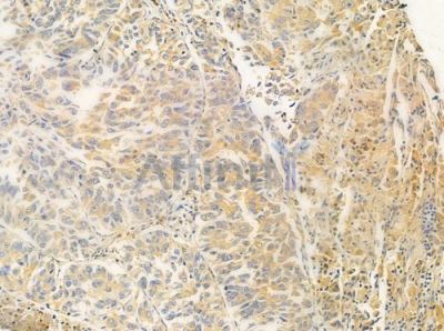 DDX20 Antibody - DF4332 at 1/100 staining human lung squamous cell carcinoma by IHC-P.