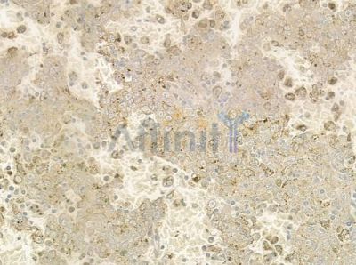 PPM1K Antibody - DF4348 at 1/100 staining human melanoma by IHC-P.