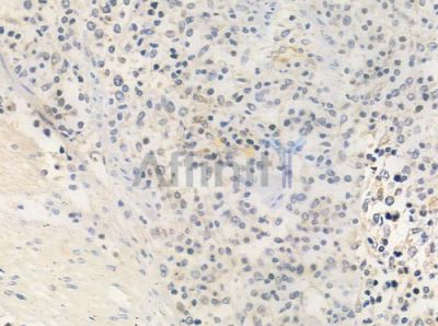 RRAGA/B Antibody - DF4392 at 1/100 staining human Hodgkin lymphoma by IHC-P.