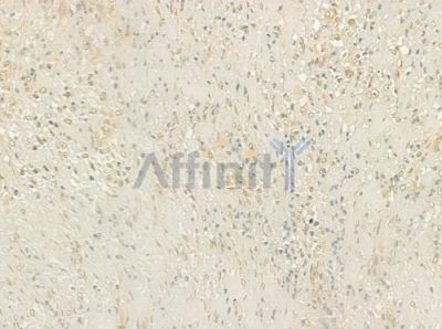 ARHGEF5 Antibody - DF4435 at 1/100 staining human prostate carcinoma by IHC-P.
