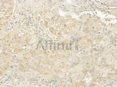 ARHGEF5 Antibody - DF4435 at 1/100 staining human lung squamous cell carcinoma by IHC-P.