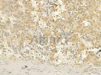 ARHGEF5 Antibody - DF4435 at 1/100 staining human melanoma by IHC-P.