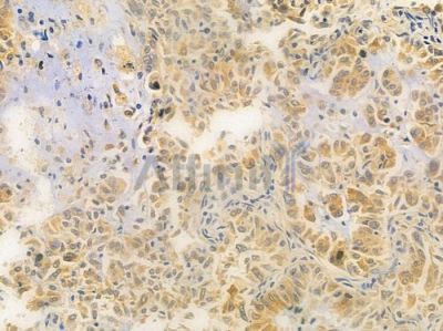 PRKY Antibody - DF4474 at 1/100 staining human lung adenocarcinoma by IHC-P.