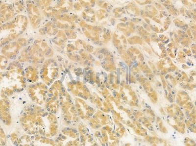 ULK3 Antibody - DF4479 at 1/100 staining human renal cell carcinoma by IHC-P.