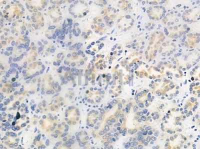 ULK3 Antibody - DF4479 at 1/100 staining human renal cell carcinoma by IHC-P.