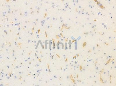 ULK3 Antibody - DF4479 at 1/100 staining human glioblastoma by IHC-P.