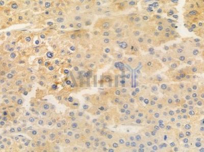 SHD Antibody - DF4496 at 1/100 staining human hepatocellular carcinoma by IHC-P.