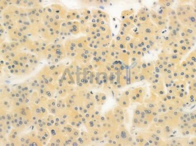 UBAC1 Antibody - DF4598 at 1/100 staining human hepatocellular carcinoma by IHC-P.