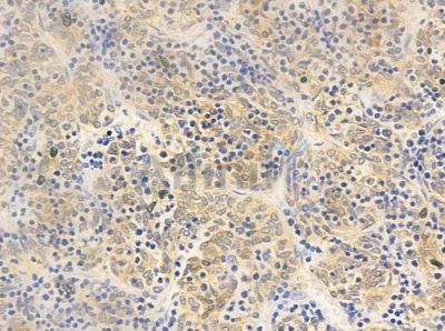 CA181 Antibody - DF4643 at 1/100 staining human thymoma by IHC-P.