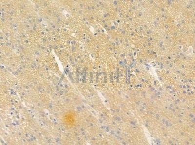 PSMD6 Antibody - DF4652 at 1/100 staining human glioblastoma by IHC-P.