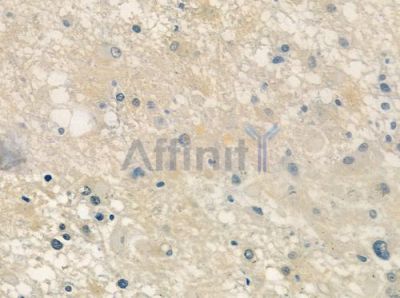 SIRT3 Antibody - DF4684 at 1/100 staining human astrocytoma by IHC-P.