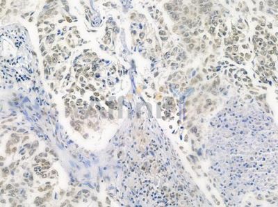 TAIP-12 Antibody - DF4725 at 1/100 staining human lung squamous cell carcinoma by IHC-P.