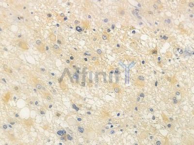 TRAF4 Antibody - DF4728 at 1/100 staining human astrocytoma by IHC-P.
