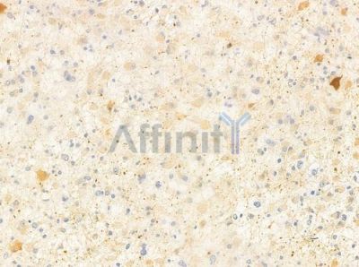 Cytochrome P450 4X1 Antibody - DF4751 at 1/100 staining human astrocytoma by IHC-P.
