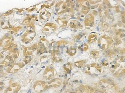 TESK2 Antibody - DF4795 at 1/100 staining human renal cell carcinoma by IHC-P.