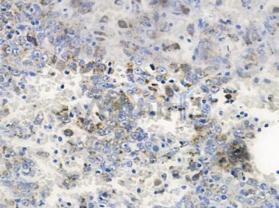 CD79A Antibody - DF4803 at 1/100 staining human melanoma by IHC-P.