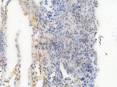 Acetyl-Histone H4 (Lys5) Antibody - DF4842 at 1/100 staining human large cell lung carcinoma by IHC-P.