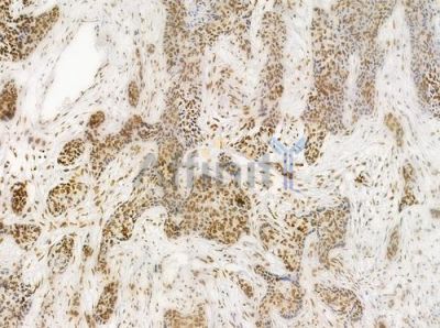 Acetyl-Histone H4 (Lys5) Antibody - DF4842 at 1/100 staining human breast carcinoma by IHC-P.