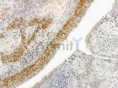 Acetyl-Histone H4 (Lys5) Antibody - DF4842 at 1/100 staining human esophageal carcinoma by IHC-P.