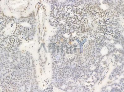 Acetyl-Histone H4 (Lys5) Antibody - DF4842 at 1/100 staining human ovarian carcinoma by IHC-P.