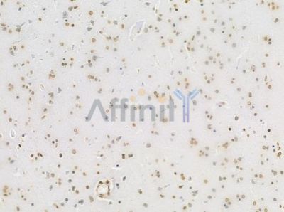 Acetyl-Histone H4 (Lys5) Antibody - DF4842 at 1/100 staining human glioblastoma by IHC-P.