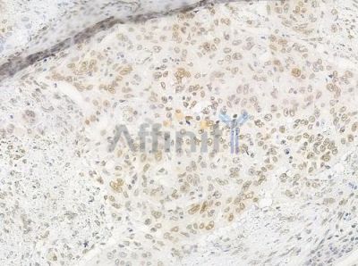 Acetyl-Histone H4 (Lys5) Antibody - DF4842 at 1/100 staining human tongue carcinoma by IHC-P.