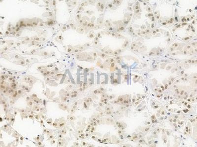 Acetyl-Histone H4 (Lys5) Antibody - DF4842 at 1/100 staining human renal cell carcinoma by IHC-P.