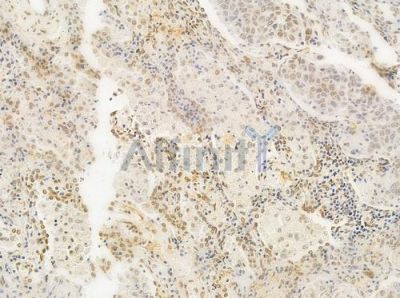 Acetyl-Histone H4 (Lys5) Antibody - DF4842 at 1/100 staining human lung squamous cell carcinoma by IHC-P.