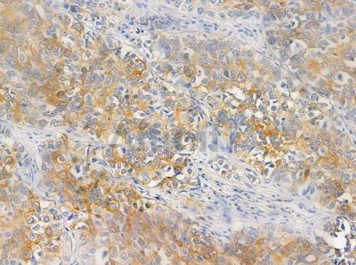 CCBP2 Antibody - DF4860 at 1/100 staining human lung squamous cell carcinoma by IHC-P.