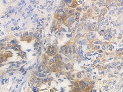 CCBP2 Antibody - DF4860 at 1/100 staining human lung squamous cell carcinoma by IHC-P.