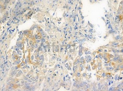 GPR110 Antibody - DF4891 at 1/100 staining human lung squamous cell carcinoma by IHC-P.